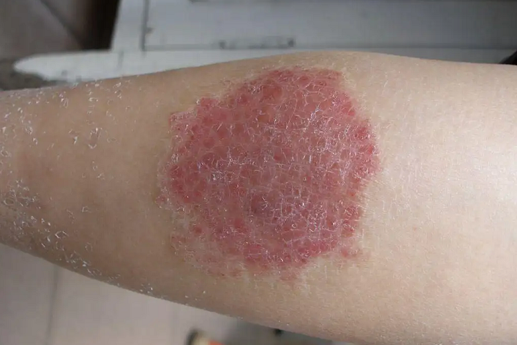 钱币状湿疹胳膊斑图 钱币状湿疹胳膊斑图