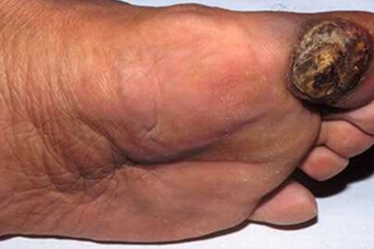 肢端雀斑痣样黑素瘤结痂图