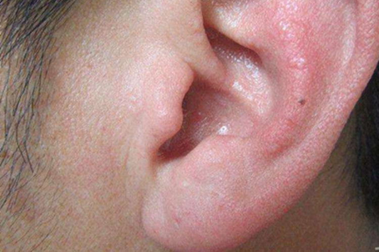 外耳湿疹耳廓发红粗糙图