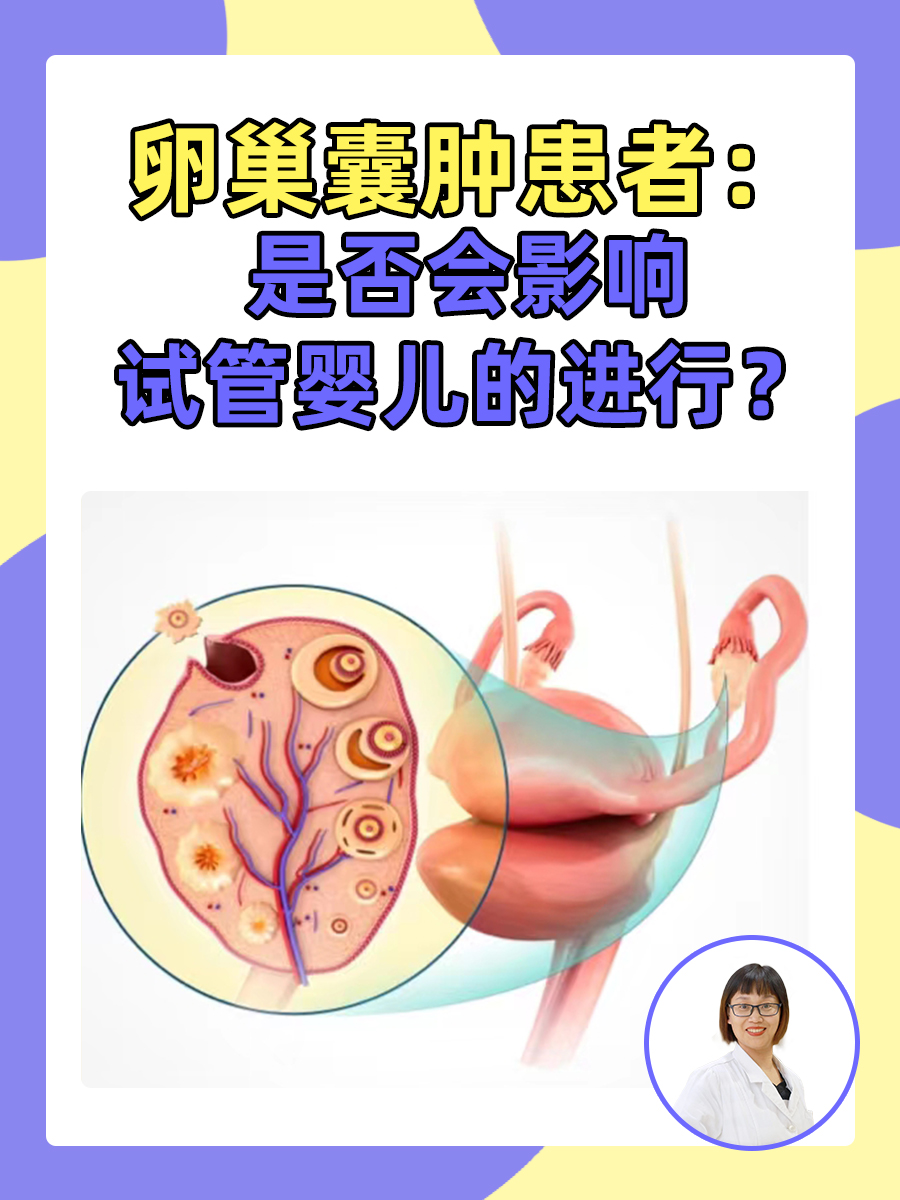 卵巢囊肿患者：是否会影响试管婴儿的进行？