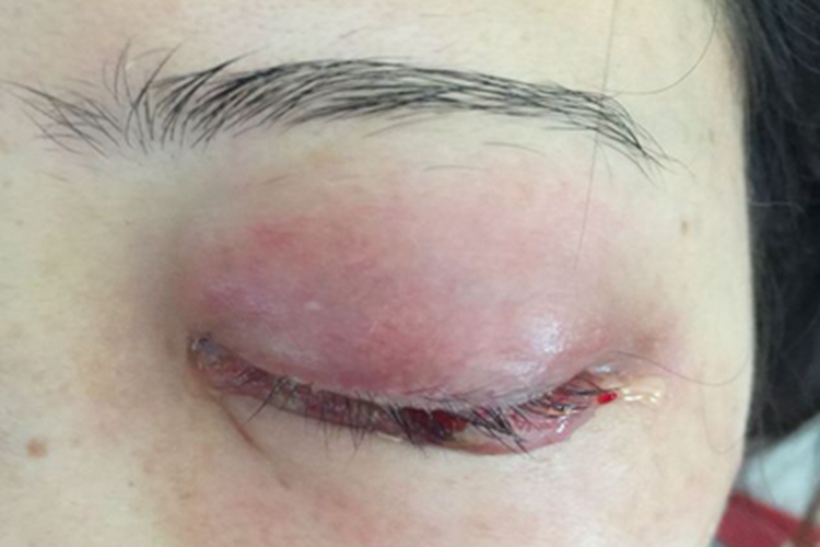 眶蜂窝织炎眼部症状图 眶蜂窝织炎眼部症状图