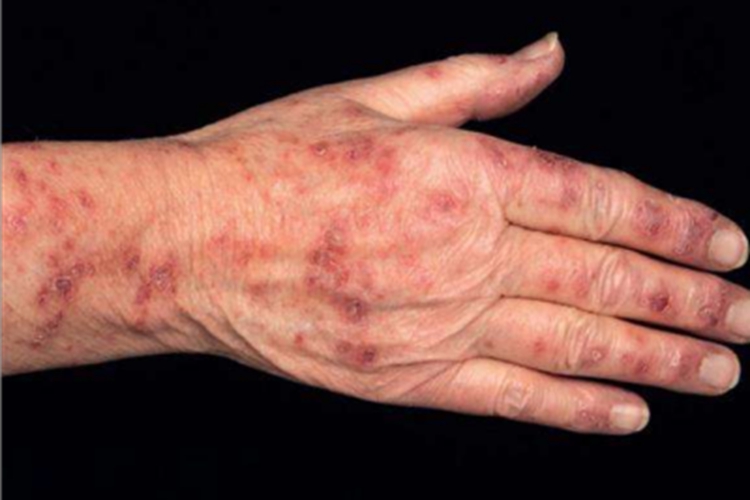 寻常狼疮血痂图