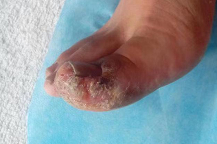 浸渍糜烂型足癣脚趾糜烂图