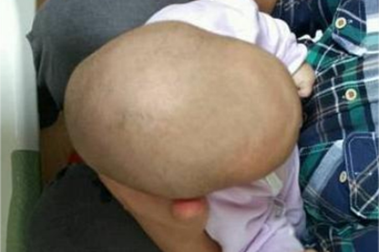 狭颅症头不圆呈舟状图 狭颅症头不圆呈舟状图