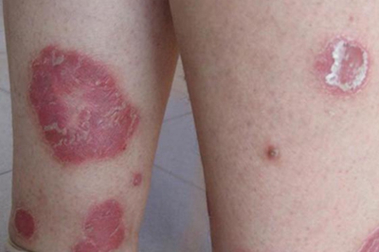 艾滋病期小腿症状图 艾滋病期小腿症状图