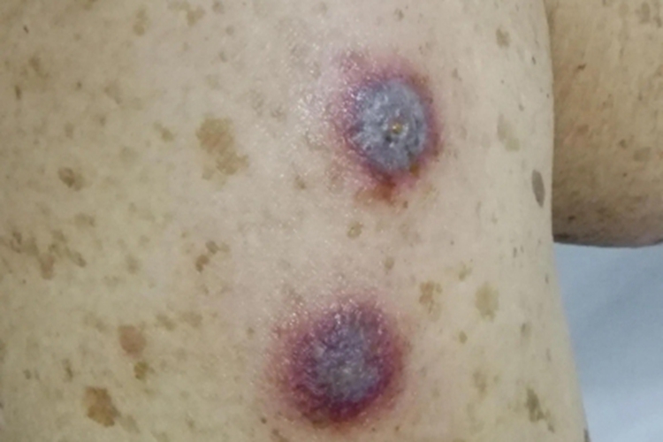 恙螨皮炎大腿水疱图 恙螨皮炎大腿水疱图