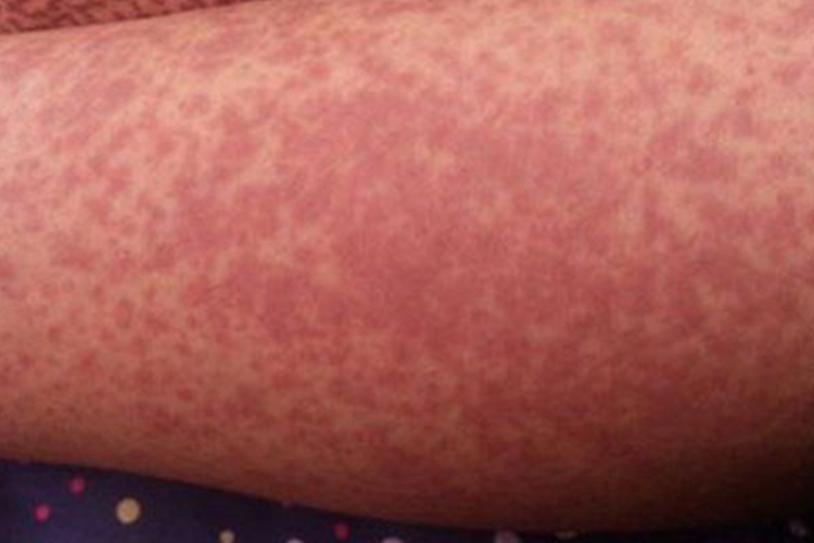 血小板减少性紫癜图