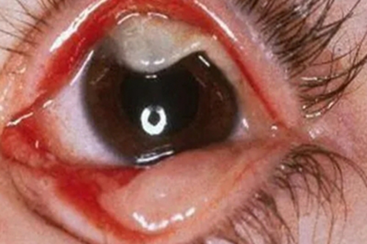 病毒性结膜炎结膜肿块图