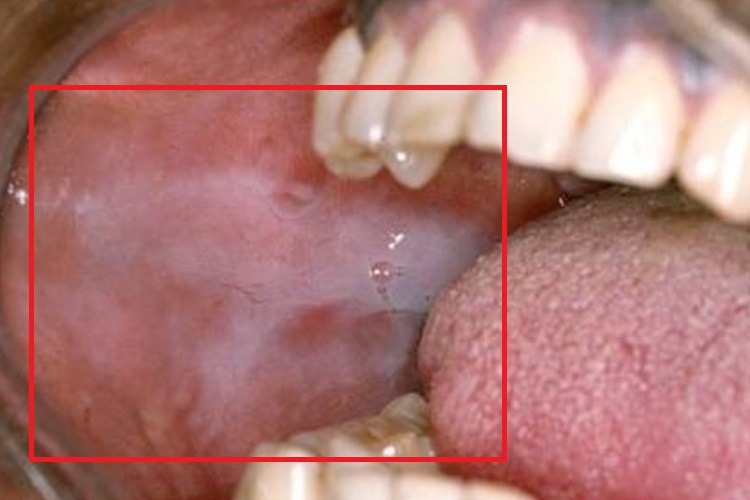 药物过敏性口炎颊黏膜水肿图 药物过敏性口炎颊黏膜水肿图