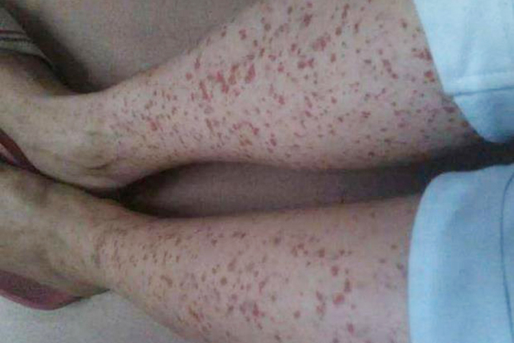 肝病皮肤瘀斑图