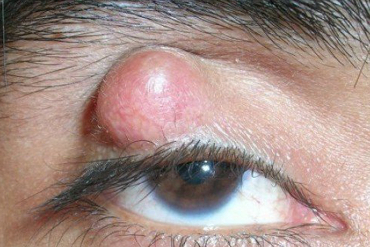 睑板腺囊肿:该疾病表现为眼睑皮下圆形肿块,一般无疼痛