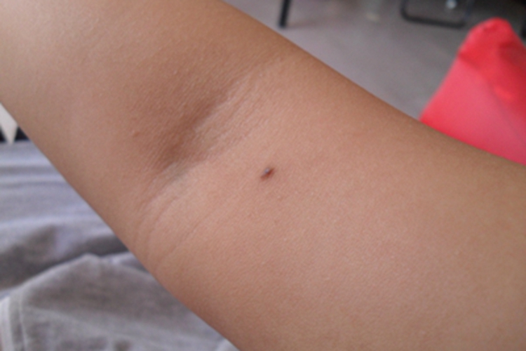 黑素细胞痣肘部症状图 黑素细胞痣肘部症状图