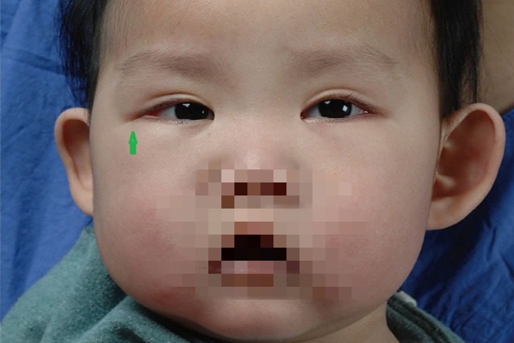 歌舞伎综合征特殊面容图