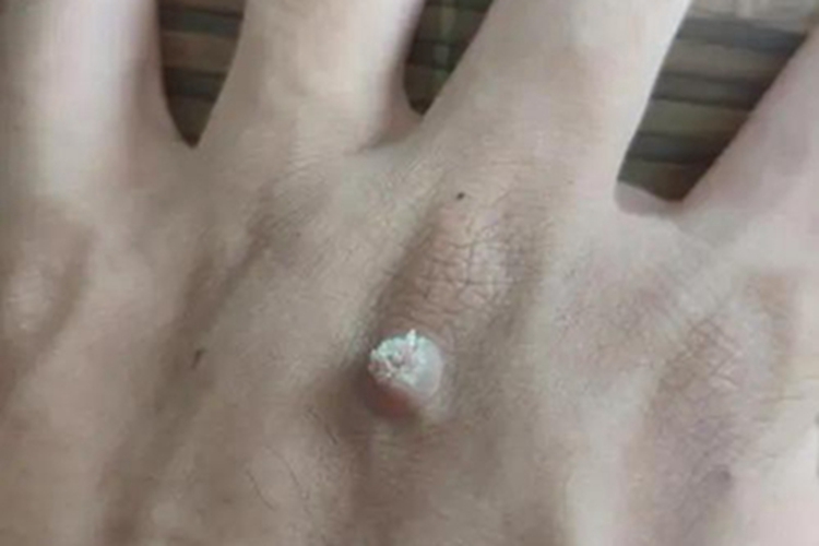 寻常疣手背起小硬包图