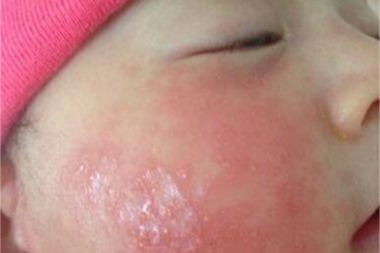 婴儿期特应性皮炎面部症状图 婴儿期特应性皮炎面部症状图