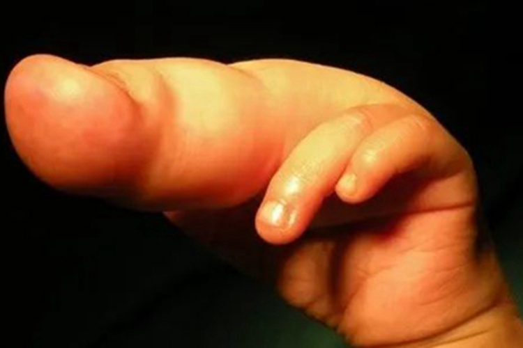 巨指畸形中指粗大图