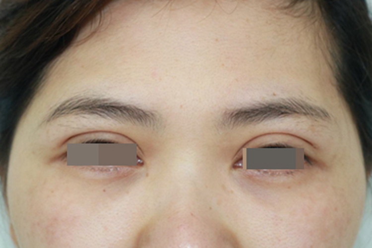 埋线双眼皮肉条图