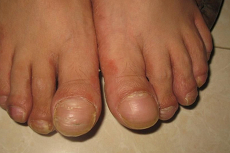 杵状指脚趾甲症状图