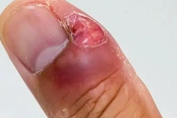 职业性指甲改变手指红肿图 职业性指甲改变手指红肿图