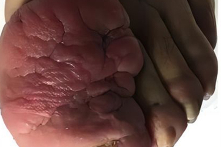 胫前黏液性水肿脚趾结节图