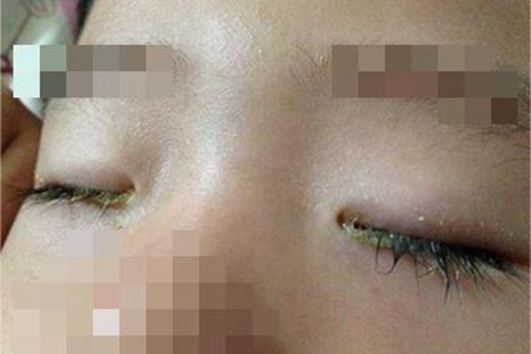 眼睑淋病黄痂图 眼睑淋病黄痂图