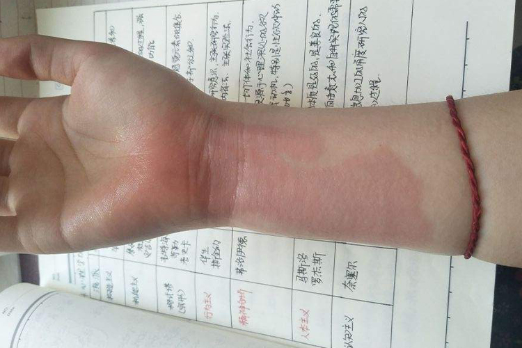 手腕Ⅰ度烧伤图
