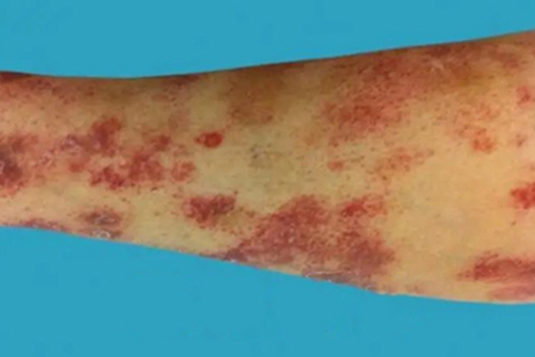 血栓性血小板减少性紫癜红斑图 血栓性血小板减少性紫癜红斑图