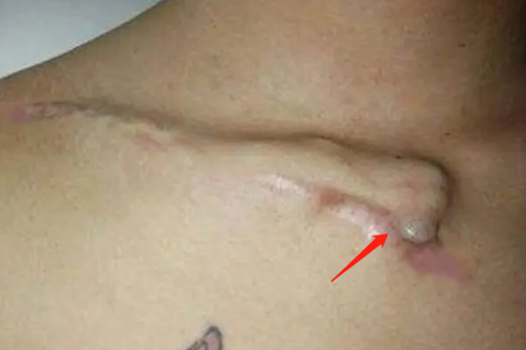 锁骨骨折下面骨头凸出来图 锁骨骨折下面骨头凸出来图