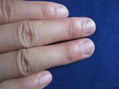 维生素A缺乏症好几个手指甲上有横纹图.jpg
