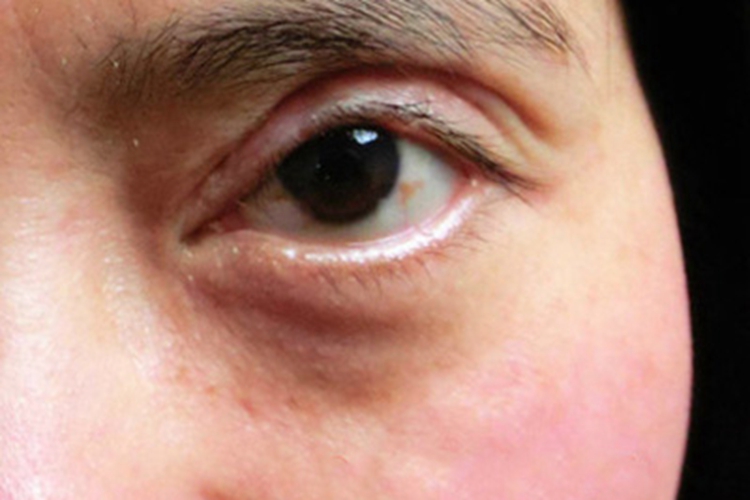 睑外翻眼睑发红变形图 睑外翻眼睑发红变形图