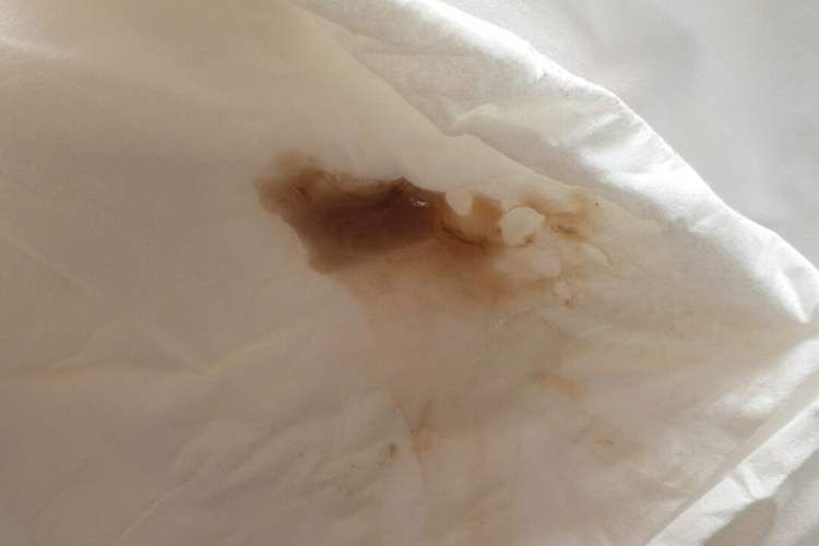 滴虫性阴道炎红褐色分泌物图 滴虫性阴道炎红褐色分泌物图