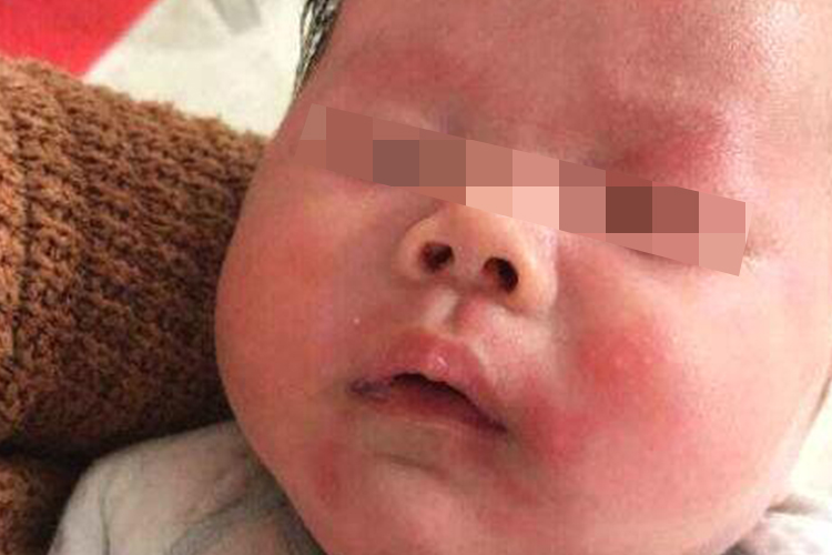 奶粉过敏导致的皮疹图 奶粉过敏导致的皮疹图