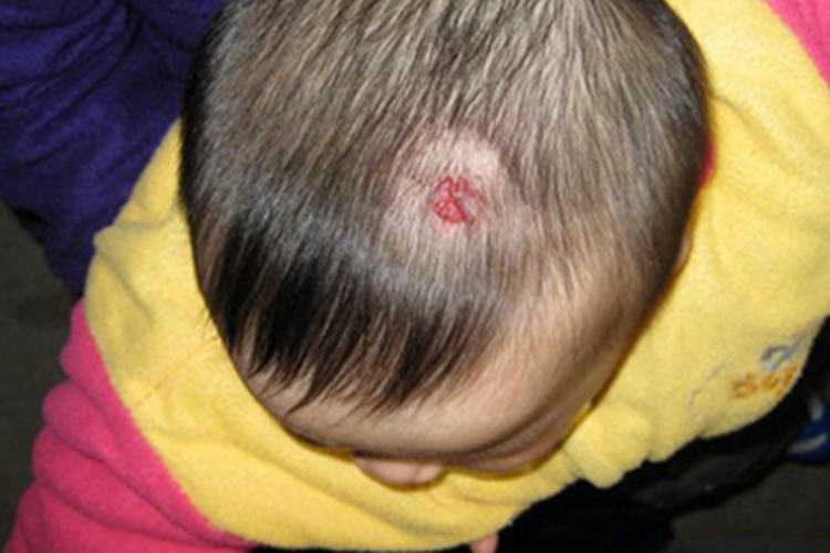 小儿血管瘤头皮小红疙瘩图