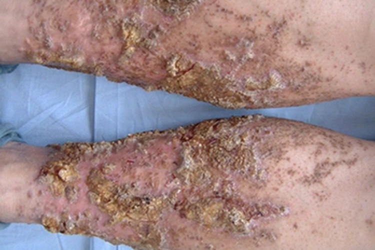 慢性苔藓样角化病小腿皮肤粗糙图 慢性苔藓样角化病小腿皮肤粗糙图