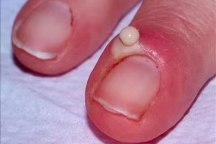 急性甲沟炎化脓图