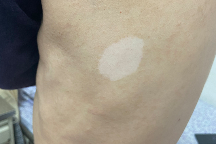 白癜风圆形白斑图