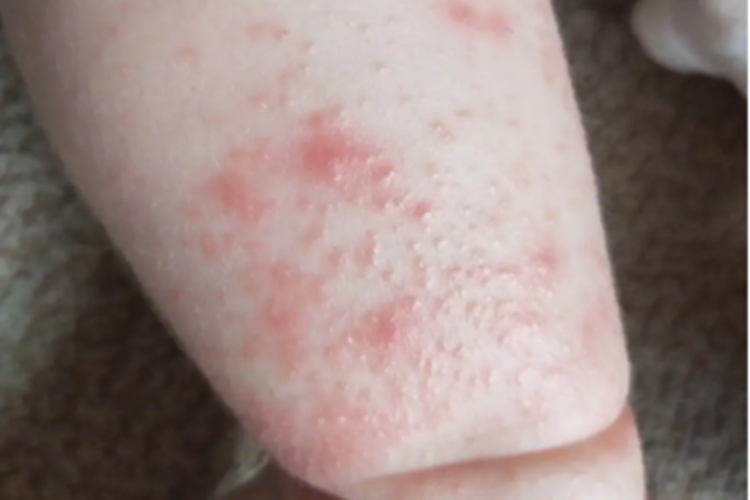 急性湿疹小腿小疙瘩图