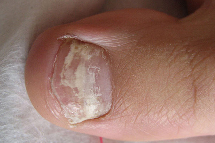 白色浅表型甲癣图