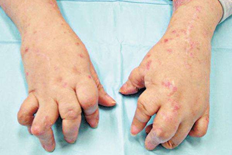 银屑病关节炎手部肿及畸形图 银屑病关节炎手部肿及畸形图