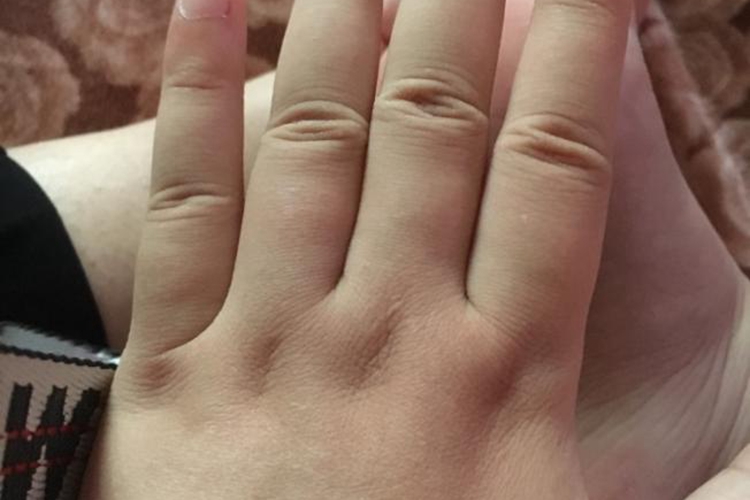 手指肿图 手指肿图