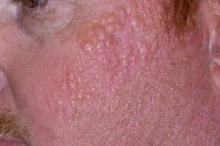 胶样粟丘疹面部症状图