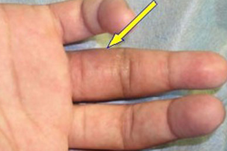 急性化脓性腱鞘炎肿胀图