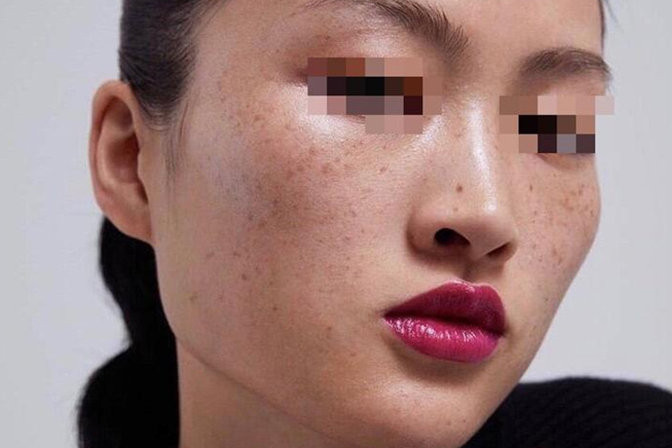 面部雀斑图