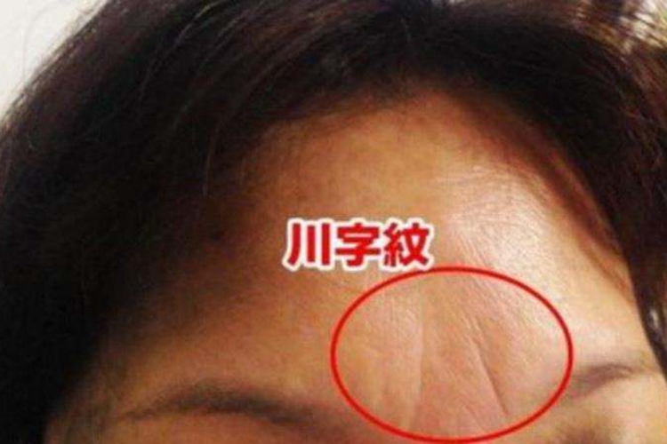 静态性眉间纹图