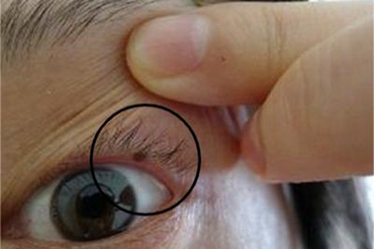 眼睑交界痣出现黑点图