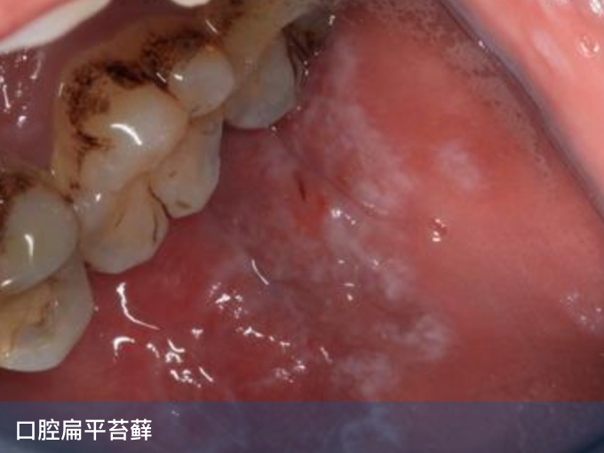 口腔扁平苔藓