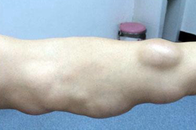 多形性脂肪瘤胳膊长肿块图