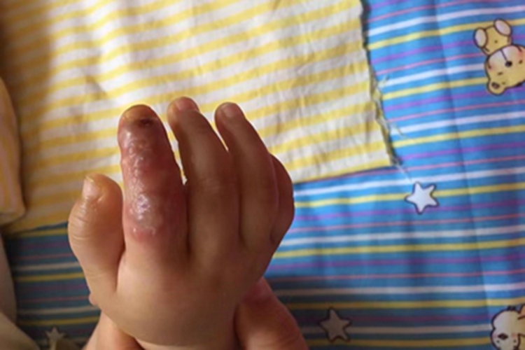 单纯疱疹手指上一片水疱图