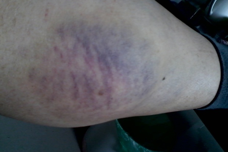 毛细血管破裂图