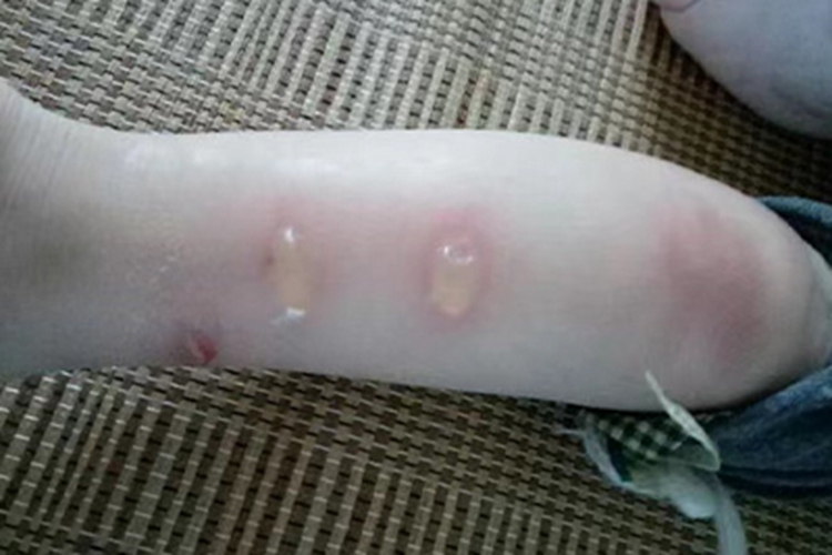 蚊性皮炎大水疱图